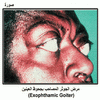      (Exophthamic Goiter)